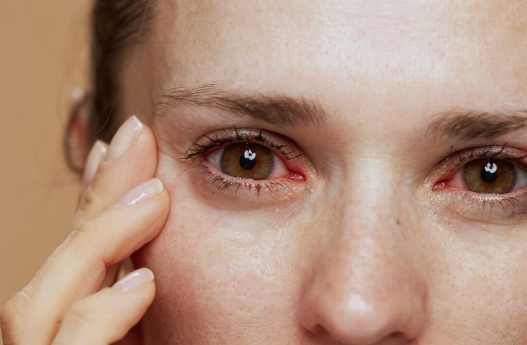 Close up of a young woman's dry, red eyes due to dry eyes.