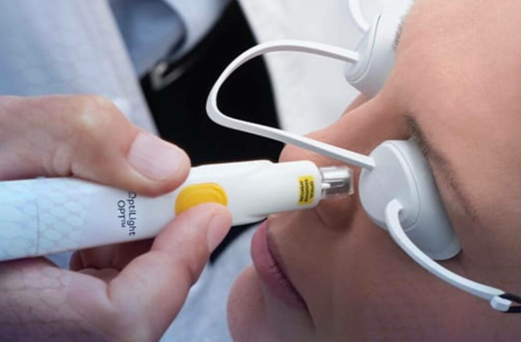 Eye doctor applying Intense pulsed light (IPL) with Lumenis Optilight as a part of dry eye treatment