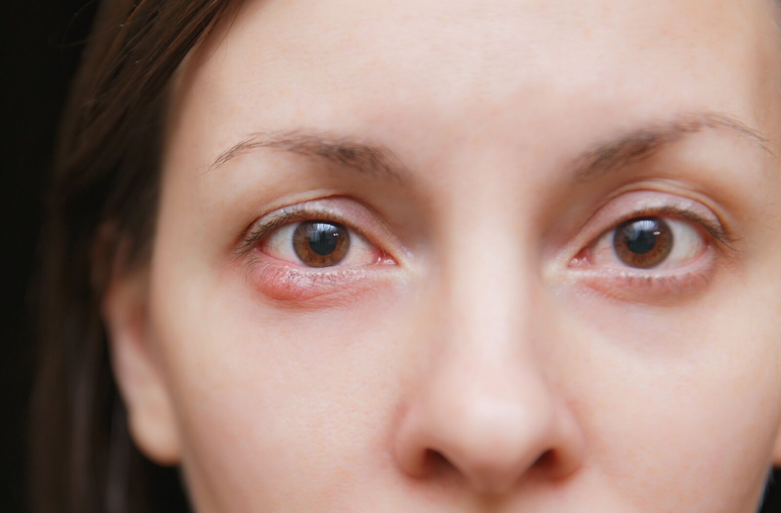 Eye with inflammation and redness near the eyelid, which could be caused by meibomian gland blockage.